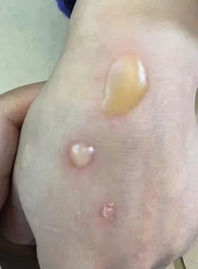 水泡影视化妆假烫伤仿真万圣节胶