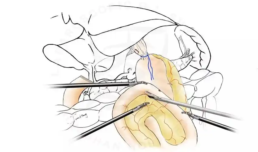图解splt——全腹腔镜全胃切除后重建的新方式