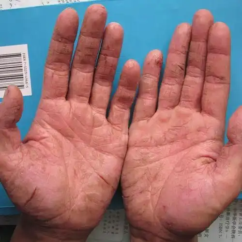 按摩_裂口_皮肤