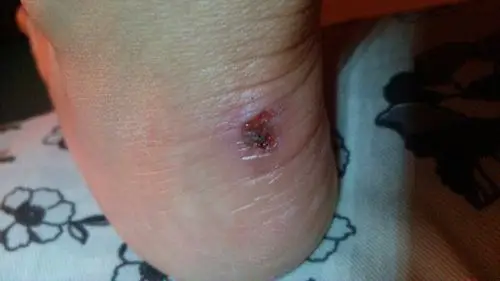 请问这脚磨破皮了该怎么处理.