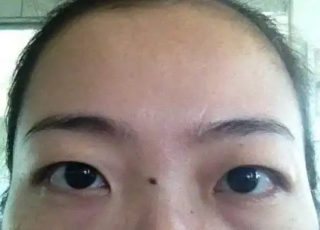 1,女人山根有痣主病灾,火灾等意外,婚姻不利,山根左边有痣,为有异性