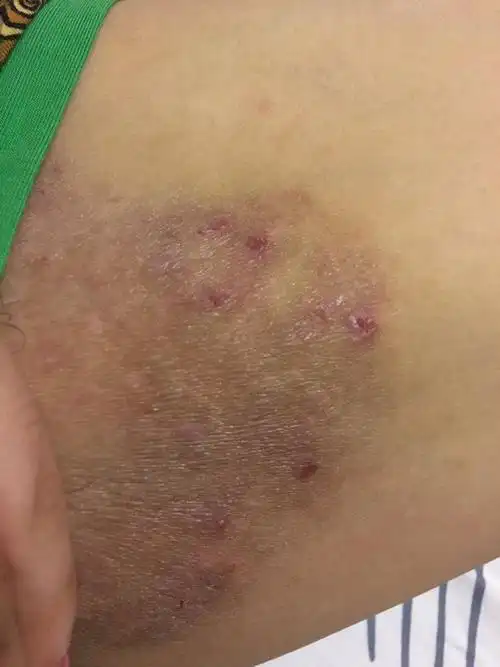 男朋友大腿内侧有水泡 一大片都是黑色的 会很痒已经快2年了