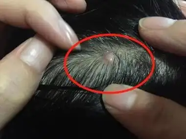 皮脂腺上皮瘤的症状和图片 - 有来医生