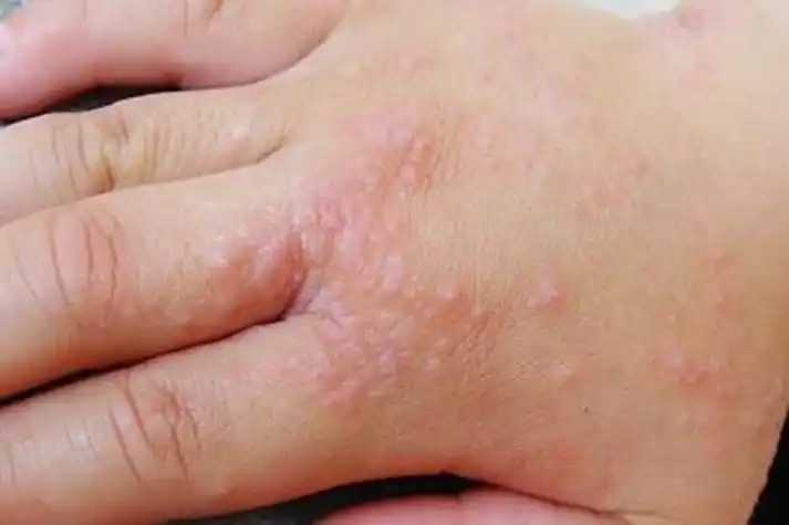 手癣图片初期症状图片大全_互联健康