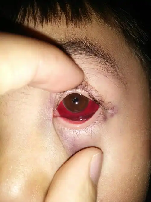 结膜下出血_介绍_发病原因_症状表现_治疗方式 - 好大夫在线