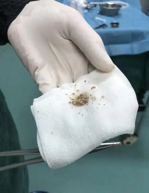 顾名思义,长在肾脏里的石头据权威医学统计,肾结石75%为草酸盐结晶