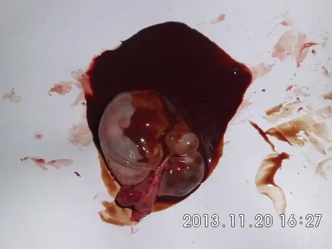 【读片】巧克力囊肿(超声图 术后标本图) [病例帖]