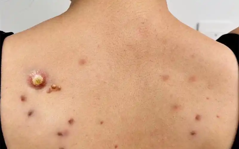 竟是螨虫在作祟!过来人分享方法秒变光滑肌肤!