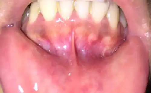 牙龈下面两个白色的圆的是什么啊?