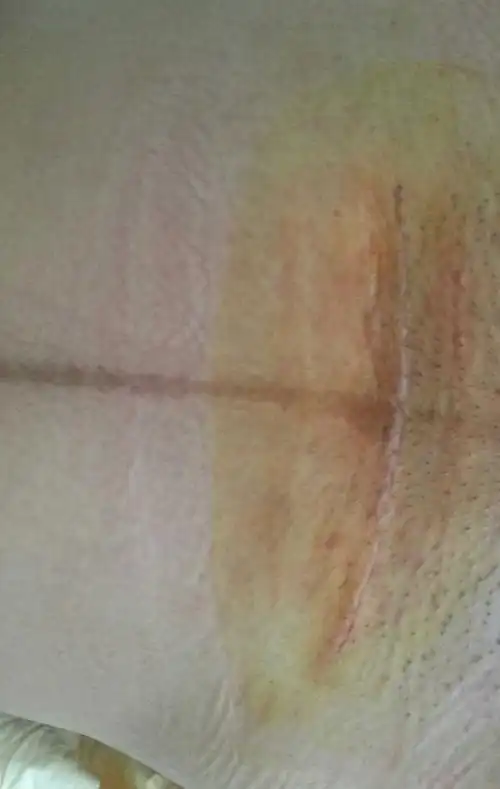 剖腹产第10天 晒晒疤痕 怕吓着没生的宝妈 图片放一楼了