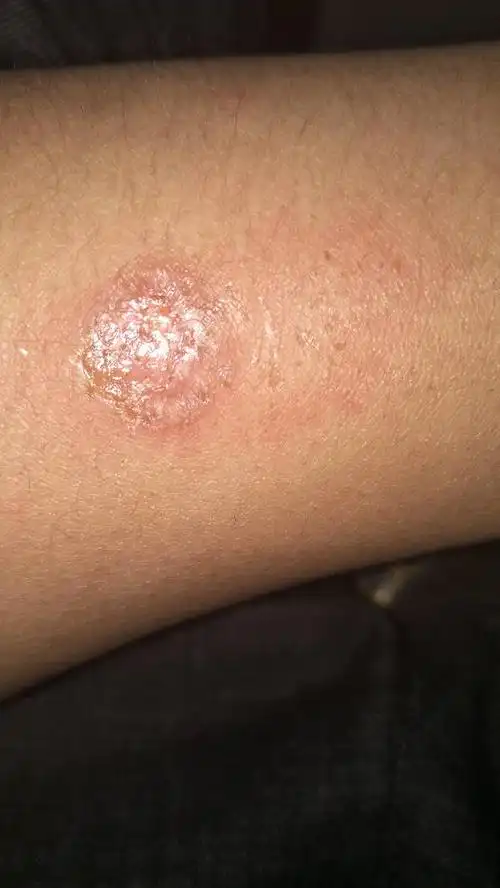 你好哥,我胳膊上有两个烟疤,这怎么去除啊!