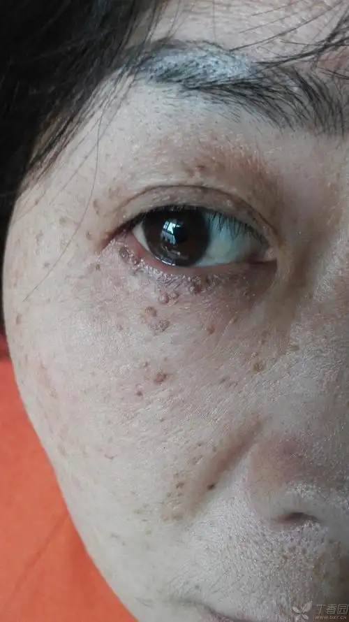 【请教】眼睑扁平丘疹考虑什么