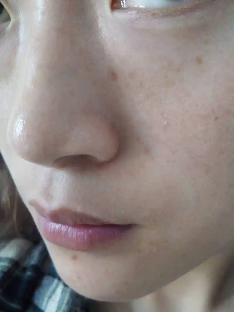 30岁脸上长斑怎么办