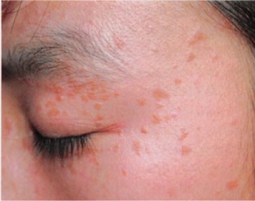 皮肤上这种赘生物竟和hpv感染有关