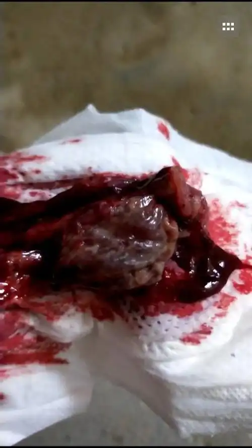 来月经从里面掉下来一个肉球,这是什么