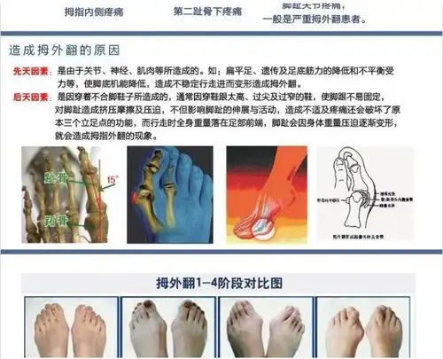 微创截骨手法整复拇外翻治疗流程,辛德瑞拉看了扛着鞋连夜跑