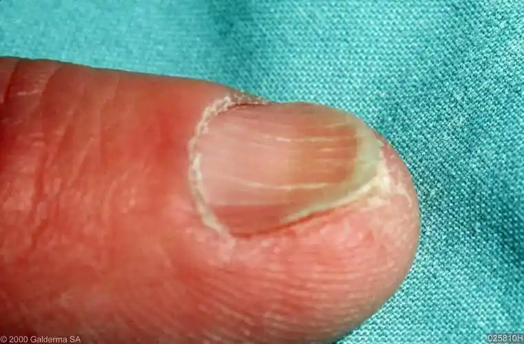 凹陷的指甲说明了什么?营养师:你的身体里缺它了!