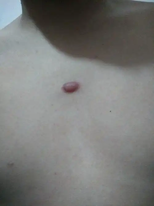 胸口长了个红色的小包