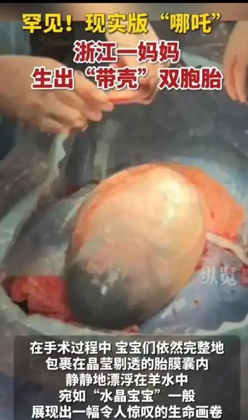 好神奇!现实版"哪吒"降生!浙江孕妇诞下带壳双胞胎!