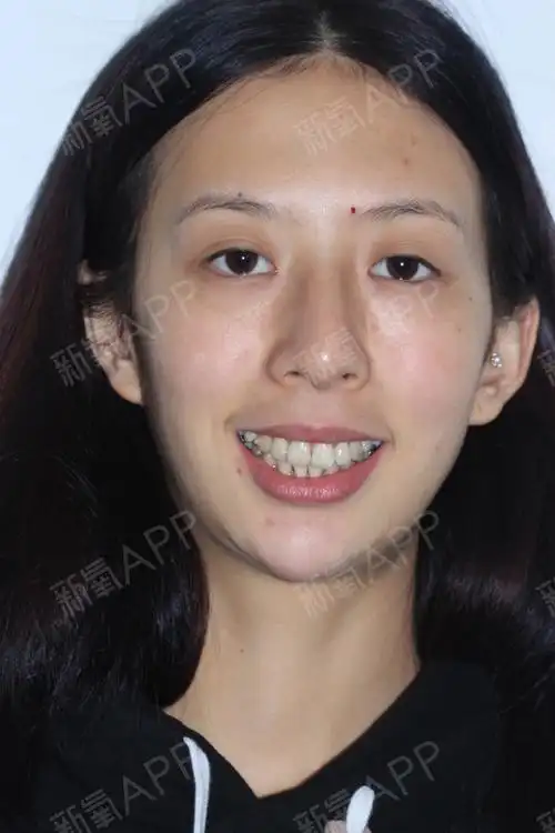 我的是上面的牙齿有点突出,刚开始有点不适应的,过了几天了