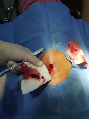 容易被忽略的皮下血肿