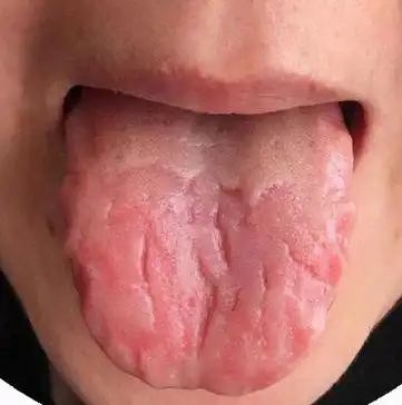 舌头上有裂纹,就如同自然界中的土地出现裂纹,裂缝.