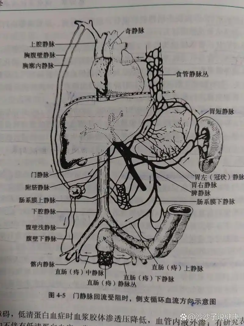 门静脉高压症:三大临床表现之一 脾大