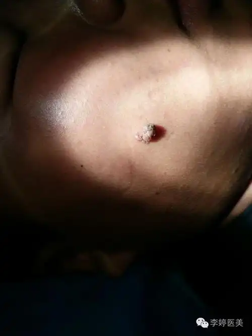 带你认识疣状痣