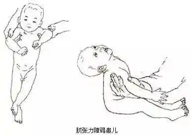 肌张力高到底是什么病