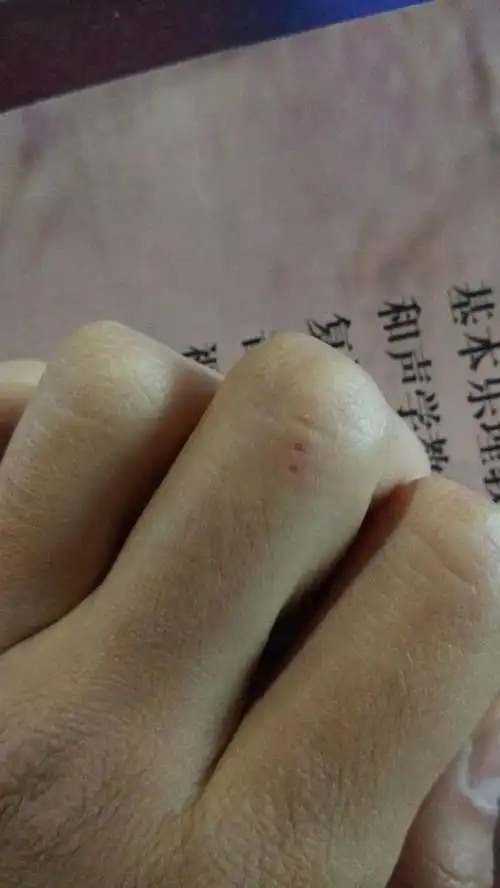 昨天晚上跟家里小泰迪玩不小心被咬了一开始没感觉后来才疼,他还没到