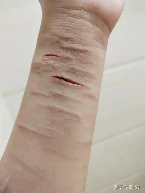 自残属于什么心理? - 知乎