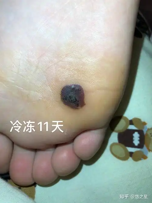 跖疣冷冻终于好了