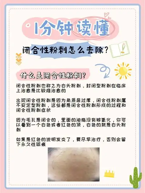 而接憧而来的还会有脸上的一系列闭口粉刺问题079292如何去更好