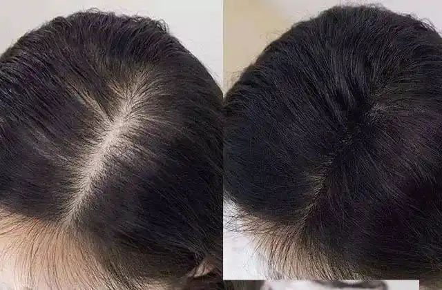 ▽ 安徽宿州53岁的周阿姨,这几年白头发越来越多,发量也越来越少,头顶