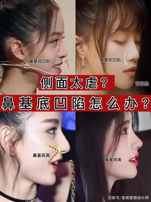 可能很多集美都会遇到这样的情况,鼻子高度还行,但是鼻基底塌陷导致面
