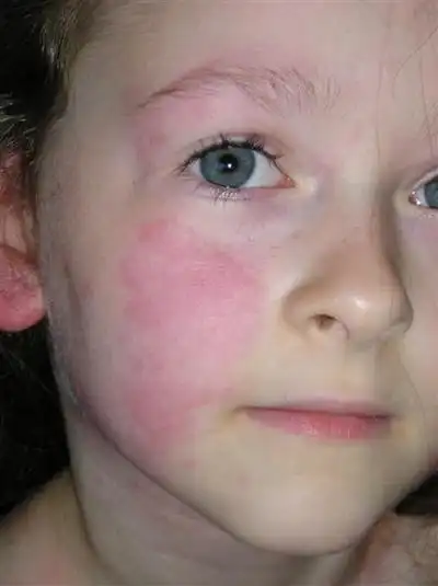 腮腺炎的症状和图片 (22)