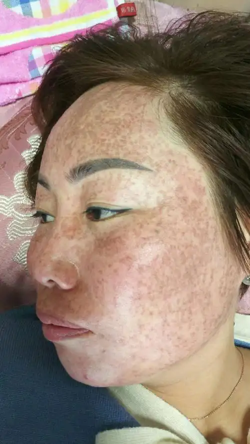 专门于:雀斑(遗传性雀斑),黑斑,黄褐斑(蝴蝶斑),日晒斑,辐射斑,老年斑