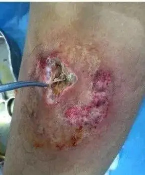 这种药物外渗后惨不忍睹,看完要长记性!