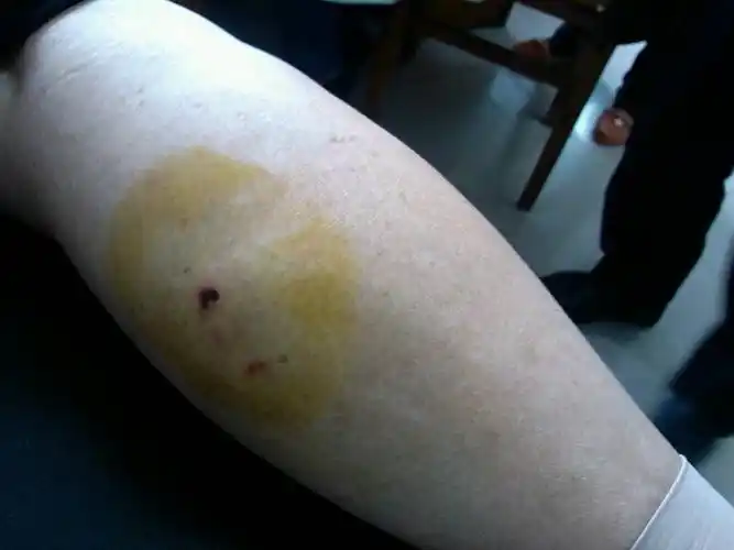 被狗咬了,这样的伤口,已经打了役苗,是否需要打血清