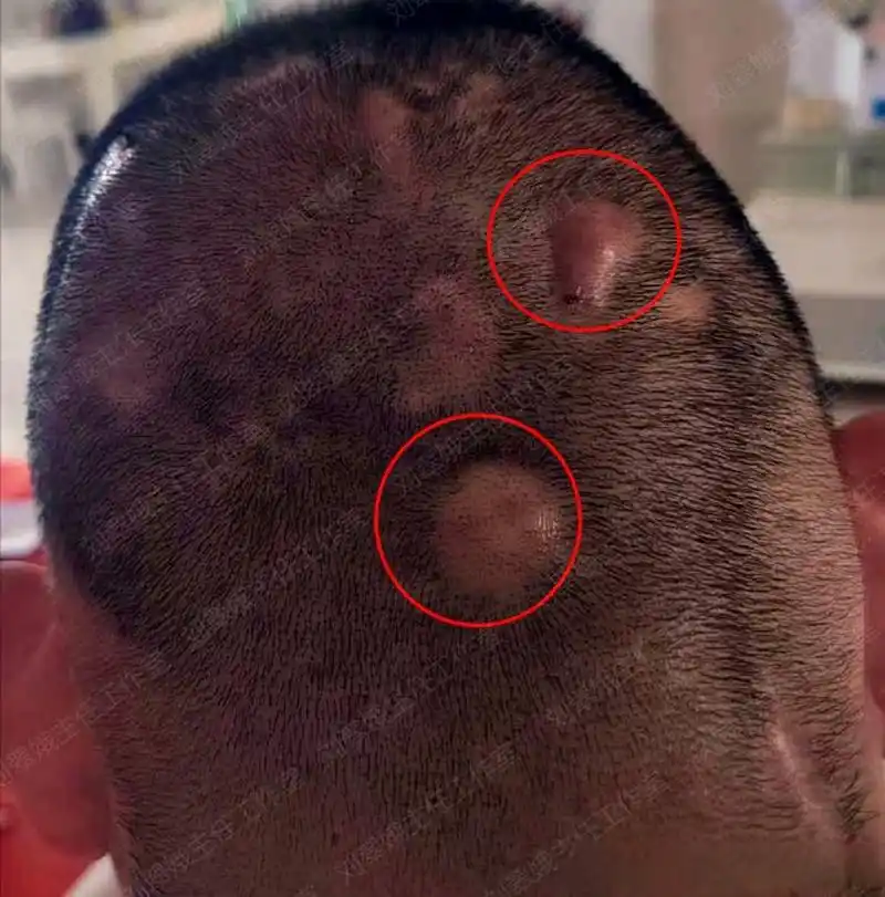 江苏的刘先生,穿掘性毛囊炎发作3年,到处求医问药,但是一直没有很好