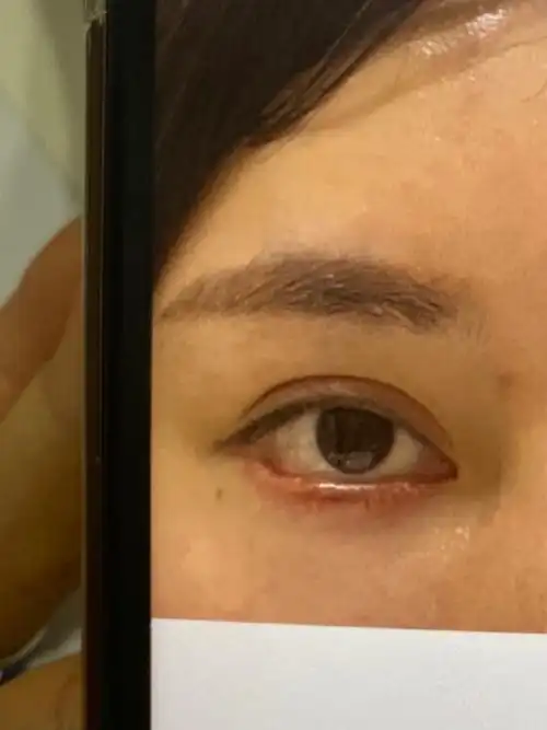 切眼袋外翻露红怎么修复,自身亲身经历的修复过程