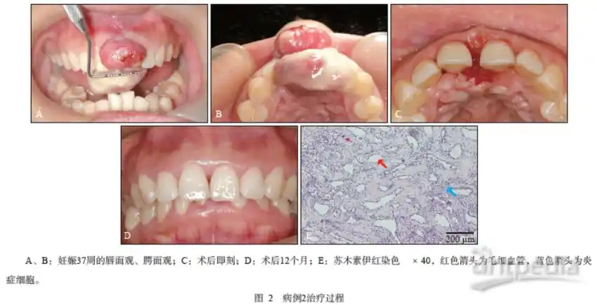 不同特点妊娠期牙龈瘤的治疗经验谈2