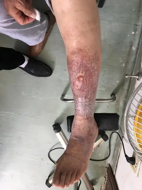 静脉曲张并发下肢溃疡.下肢静脉血栓形成.经久不愈的溃疡.