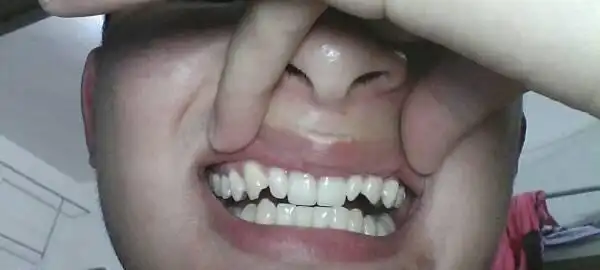 请问各位医生,我想把上排牙齿中,两颗门牙左右各三颗牙齿换掉(不包括