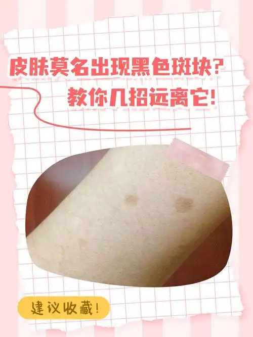 皮肤莫名出现黑色斑块?教你几招远离它!