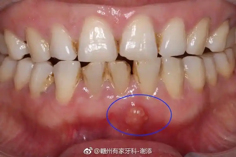 根尖脓肿脓肿已消退通过完善的根管治疗,绝大多数的根尖周病变都能