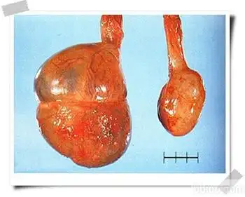 睾丸囊肿的症状都有什么