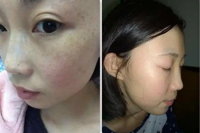 黄雀斑是怎么形成的祛斑一个百试百灵的有效祛斑秘方