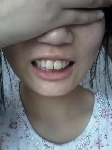 我有两颗大板牙往外突,一说话就能看见,同学们都叫我兔牙,很不喜欢