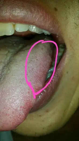 发病约一个月了,总感觉左侧舌边缘有异样的感觉,很